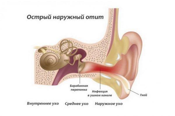 Отит у дорослих: симптоми і лікування