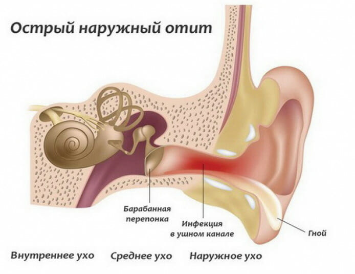 Отит у грудного ребнка Що робити щоб не нашкодити малюкові