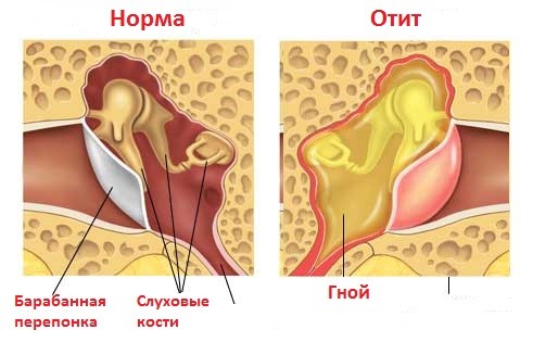 Отит види симптоми і лікування Отит види симптоми і лікування