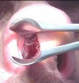 Озена складне захворювання вимагає своєчасного лікування Озена складне захворювання вимагає своєчасного лікування