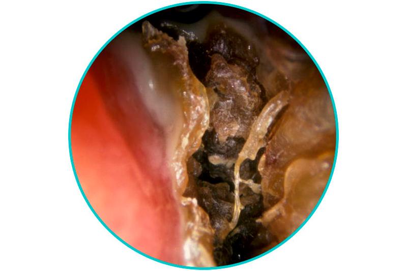Озена складне захворювання вимагає своєчасного лікування Озена складне захворювання вимагає своєчасного лікування