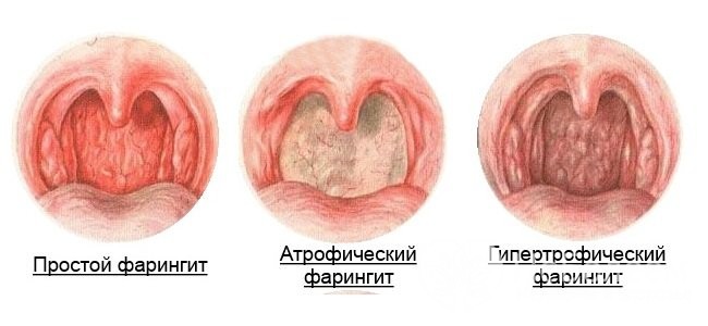 Ознаки фарингіту у дитини і як правильно його лікувати