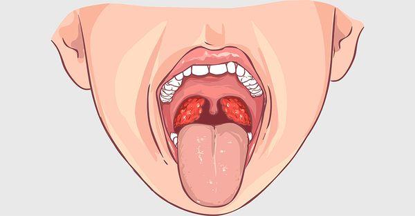 Ознаки фарингіту у дитини і як правильно його лікувати Ознаки фарингіту у дитини і як правильно його лікувати