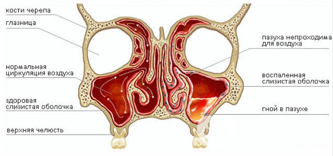 Ознаки гаймориту у дітей різного віку