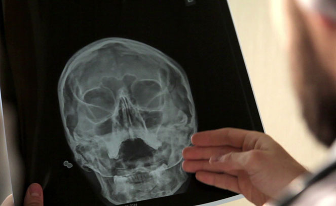 Ознаки гаймориту у дорослих і можливе лікування проблеми