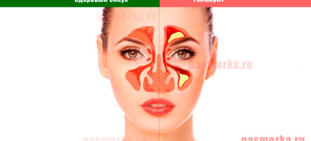Ознаки гаймориту у дорослих і можливе лікування проблеми