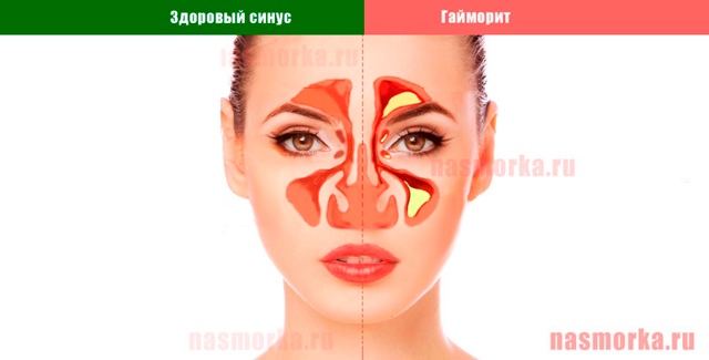 Ознаки гаймориту у дорослих і можливе лікування проблеми
