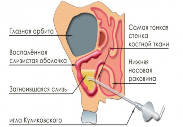 Ознаки гаймориту у дорослих як лікувати