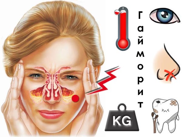 Ознаки гаймориту як лікувати у дітей і дорослих