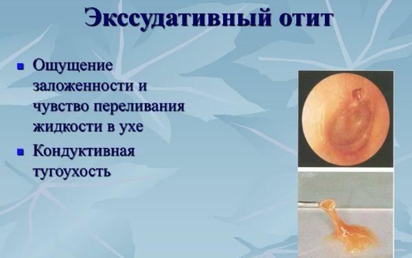 Ознаки і лікування ексудативного отиту Ознаки і лікування ексудативного отиту