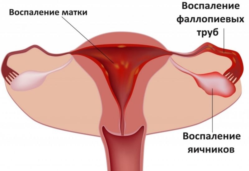 Ознаки і лікування уретриту у жінок