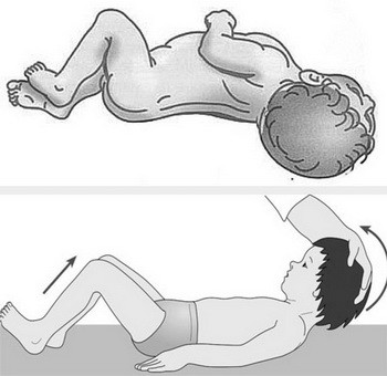 Ознаки менінгіту у дітей, висип при менінгіті (фото), як розпізнати менінгіт – симптоми у дітей