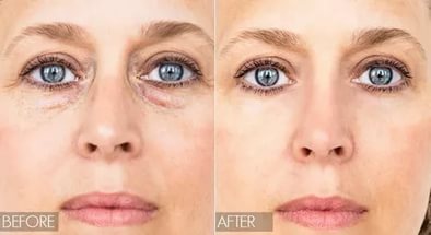 Ознаки набряку слизової носа і кращі протинабрякові препарати Ознаки набряку слизової носа і кращі протинабрякові препарати