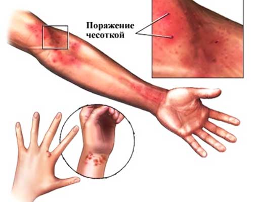 Причини появи прищів у ліктьових згинах у дорослих та методи боротьби з висипаннями