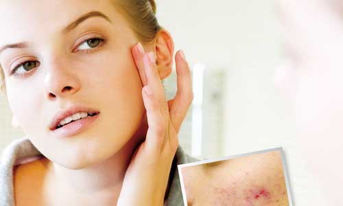 Застосування масла розмарину в лікуванні прищів